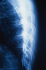 X-ray of human ribs, close-up - PMF00418