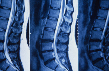 X-ray of human spine, (multiple image) - PMF00417