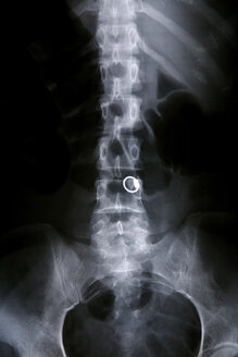 Röntgenbild der Halswirbelsäule - PMF00546