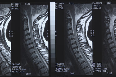 x-ray image of spine, close up - ASF004141