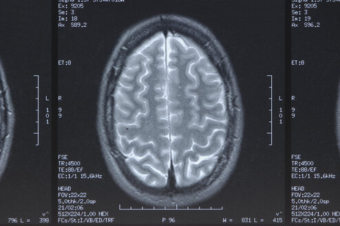 x-ray image head, close up - ASF004145