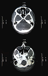 Ct-Scan-Bericht von Kopf und Schädel, Nahaufnahme - JMF000045