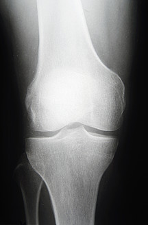 Röntgenbild des Knies, Nahaufnahme - JMF000119