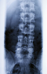 Radiograph of lumbar spine - JMF000254