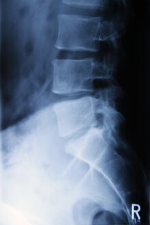 Röntgenbild der Lendenwirbelsäule - JMF000255