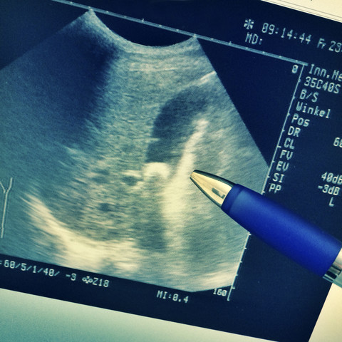 Ultraschallbild, Stift zeigt auf einen Gallenstein, Freiburg, Deutschland: Cholelithiasis, Abdomen, Ultraschall, lizenzfreies Stockfoto