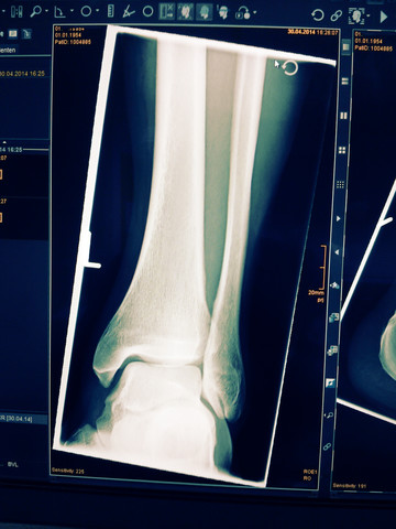 Chirurgische Notfallambulanz, Röntgenbild eines linken Knöchels mit Fibula, Tibia und Talus (Sprunggelenk), lizenzfreies Stockfoto