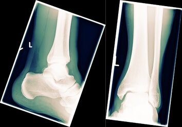 Chirurgische Notfallambulanz, Röntgenbild eines linken Sprunggelenks mit Wadenbein, Schienbein, Sprungbein (Talus), Fersenbein (Calcaneus), Kahnbein (Skaphoid) und Mittelfußknochen - LAF000775