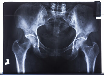 Pelvis x-ray - BZF000092
