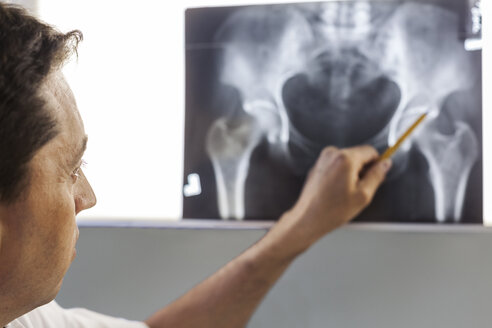 Doctor pointing at x-ray of a pelvis - BZF000094
