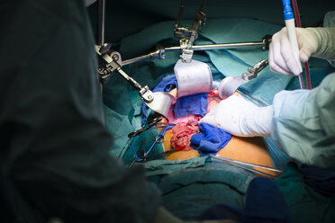 Chirurgen bei der Transplantation einer Leber - MWE000015