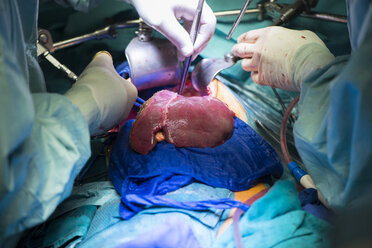 Chirurgen bei der Transplantation einer Leber - MWE000017