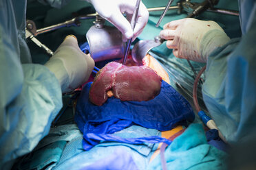 Surgeons transplanting a liver - MWE000017