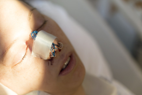 Patient after a nose operation stock photo