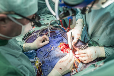 Chirurgen, die eine Bypass-Operation am Herzen durchführen - MWEF000033