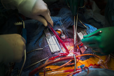 Herzklappenoperation - MWEF000056