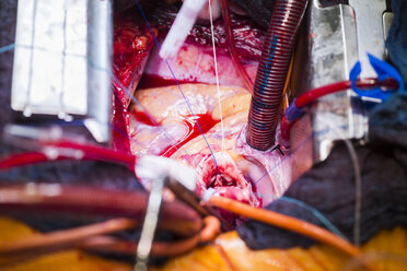 Herzklappenoperation - MWEF000057