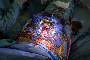 Herzklappenoperation - MWEF000078