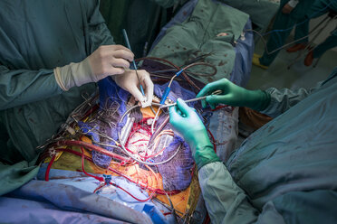Herzchirurgen bei einer Herzklappenoperation - MWEF000079