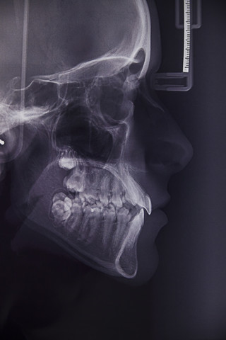 Röntgenbild der Zähne einer jungen Frau, lizenzfreies Stockfoto