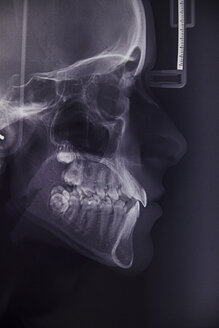 Röntgenbild der Zähne einer jungen Frau - ZEDF000237