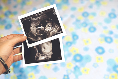 Frau Hände halten zwei Baby-Mädchen-Ultraschall, 4D-Ultraschall, lizenzfreies Stockfoto