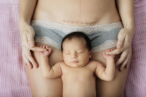Newborn baby girl lying on mother's thighs near to a recent c-section scar with staples stock photo