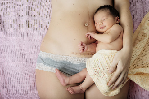 Newborn baby girl lying on mother's thighs near to a recent c-section scar with staples stock photo