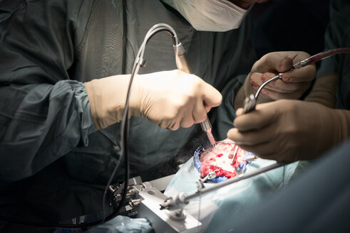 Neurochirurgen öffnen den Schädel während einer Operation - MWEF00113