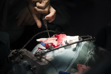 Neurochirurg beim Verschrauben des Schädelknochens während einer Operation - MWEF00135