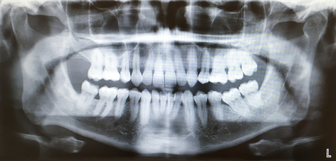 X-ray of a set of teeth stock photo