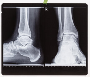 Röntgenaufnahme des rechten Fußgelenks - FSIF01588
