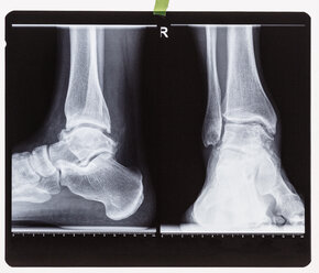 X-ray of the right foot ankle joint - FSIF01588