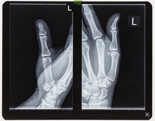 X-ray image of human hand - FSIF01589
