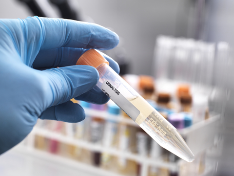 Medical technician preparing a human urine sample for clinical testing stock photo
