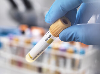 Medical technician preparing a human sample for hepatitis testing - ABRF00138