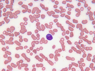 Nahaufnahme von Zellen der myeloischen Leukämie - CUF00573