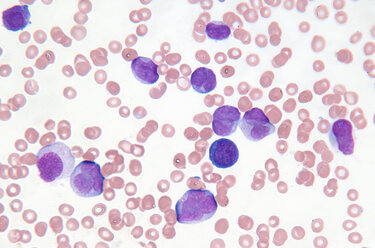 Close up of myelogenous leukemia cells - CUF00574