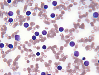 Neoplastische Lymphozytenzellen im Blut - CUF00575
