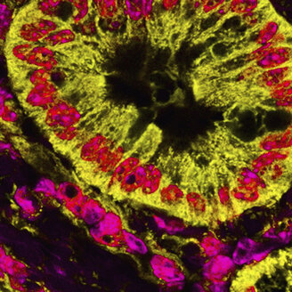 Mikroskopische Aufnahme von mitochondrial gefärbten Bauchspeicheldrüsenkrebszellen - CUF06134