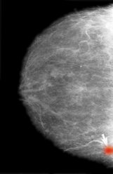 Mammogramm von kolloidalem Brustkrebs - CUF06141