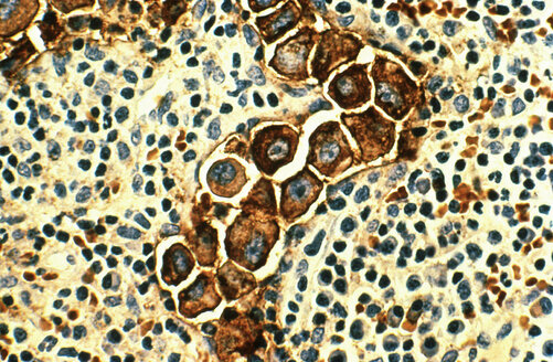 Metastasierender Brustkrebs in den Lymphknoten - CUF06152