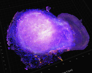 Transparent tumor tomography visualising tumor microenvironment, showing cytotoxic T cells attacking tumor after treatment - CUF06154