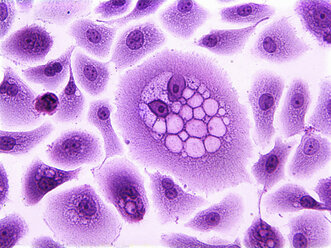 Koilocytes, squamous epithelial cells, altered by human papillomavirus - CUF06161