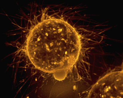 Epifluoreszenzmikroskopie von Mikrotentakeln auf der Oberfläche von Brusttumorzellen - CUF06166