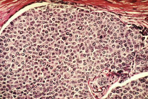 Mikroskopische Aufnahme von Brustkrebszellen - CUF06168