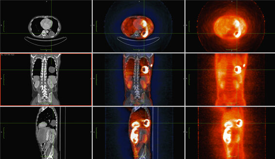 Bild aus einer ko-registrierten PET-CT-Studie mit einem Dual-Modality-Scanner. Patient mit multiplen metastatischen Läsionen in Leber und Lunge. PET-Daten überlagert mit einem axialen CT-Scan-Schichtbild durch die Lungenmetastasen - CUF28253