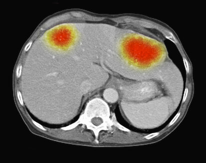 Bild aus einer ko-registrierten PET-CT-Studie mit einem Dual-Modality-Scanner. Patient mit multiplen metastatischen Läsionen in Leber und Lunge. PET-Daten überlagert mit einem axialen CT-Scan-Schichtbild durch die Lebermetastasen - CUF28254