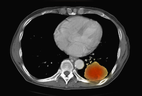 Bild aus einer ko-registrierten PET-CT-Studie mit einem Dual-Modality-Scanner. Patient mit multiplen metastatischen Läsionen in Leber und Lunge. PET-Daten überlagert mit einer axialen Schicht des CT-Scans durch die Lungenmetastasen - CUF28257