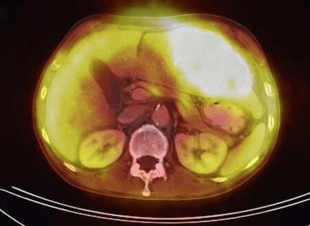 Bild aus einer ko-registrierten PET-CT-Studie mit einem Dual-Modality-Scanner. Patient mit multiplen metastatischen Läsionen in Leber und Lunge. PET-Daten überlagert mit einem axialen CT-Scan-Schichtbild durch die Lebermetastasen - CUF28259